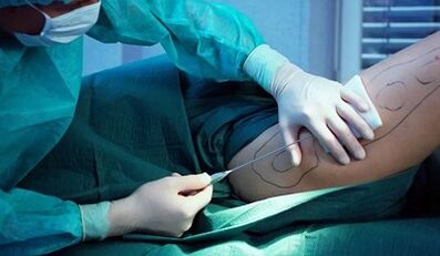 Chirurgie fir Gewiichtsverloscht